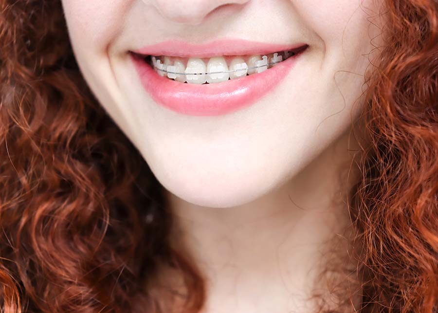 Ceramic braces Gainesville and Lake City FL orthodontists